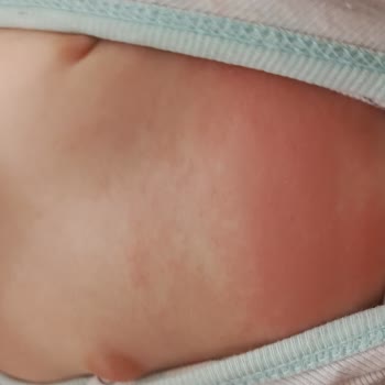 Mustela İle Geçmeyen Kızarıklıklar