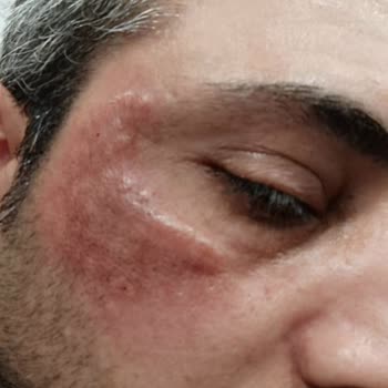 Medipol Sağlık Grubu Özel Hastanede Yüz Lekeleri Tedavi Süreci Ve Sonuçları