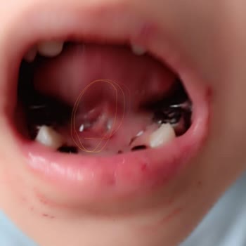 Yeditepe Üniversitesi Diş Hastanesi Onay Almadan Çocuğumun 5 Sağlam Dişini Çekti