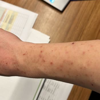 Elit Clean Güzellik Lazer Sonrası Vücudum Yandı