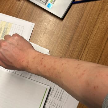 Elit Clean Güzellik Lazer Sonrası Vücudum Yandı