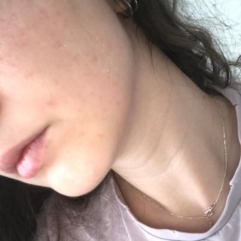 Yves Rocher Sebo Pure Sivilce Oluşumu