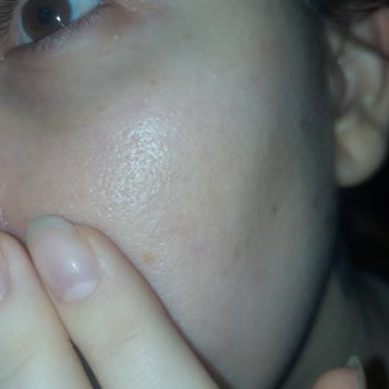 Ducray Tahriş Etti Kuruttu