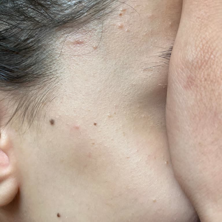 Watsons Pure Beauty Sivilce Yaptı