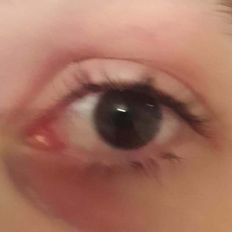 Bursa Şehir Hastanesi Gözüm İltihap Kaptı.