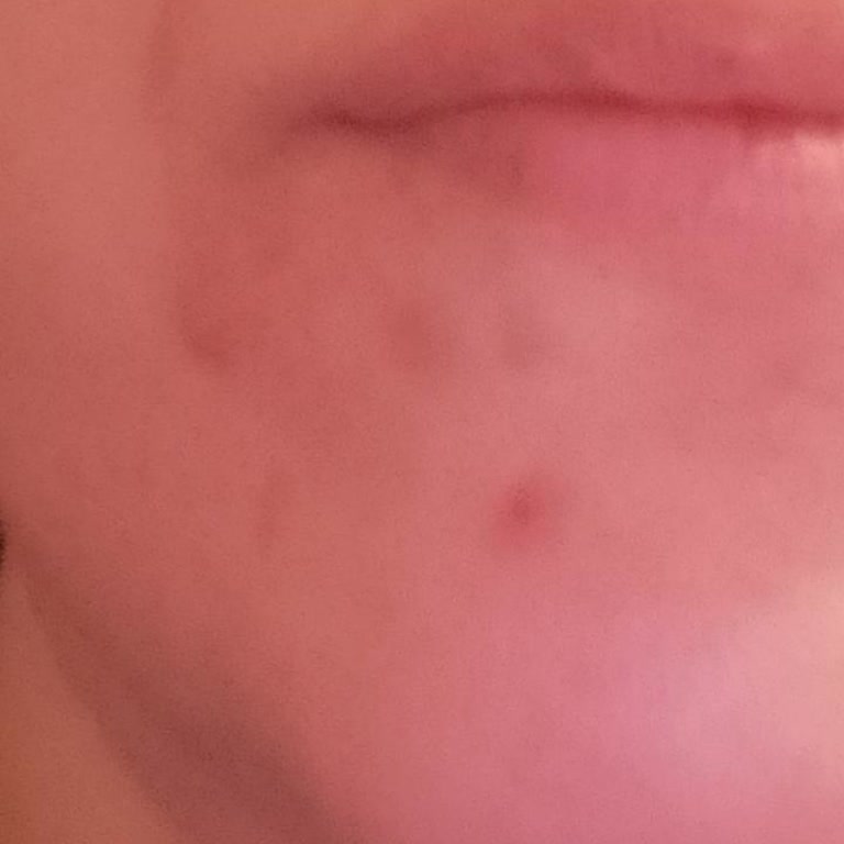 Koreaco Yüz Serumları Yüzümde Lekelere Neden Oldu