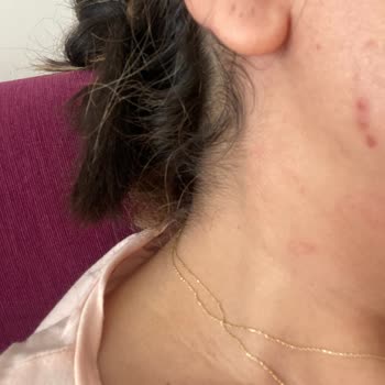 Abdi İbrahim Cilt Bakım Kremi Sonrası Yaşanan Sivilce Sorunu