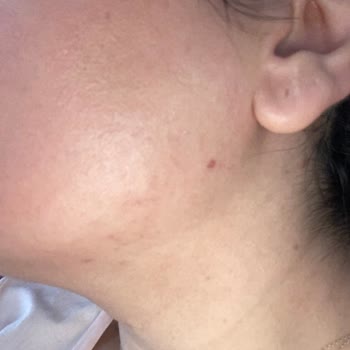 Abdi İbrahim Cilt Bakım Kremi Sonrası Yaşanan Sivilce Sorunu