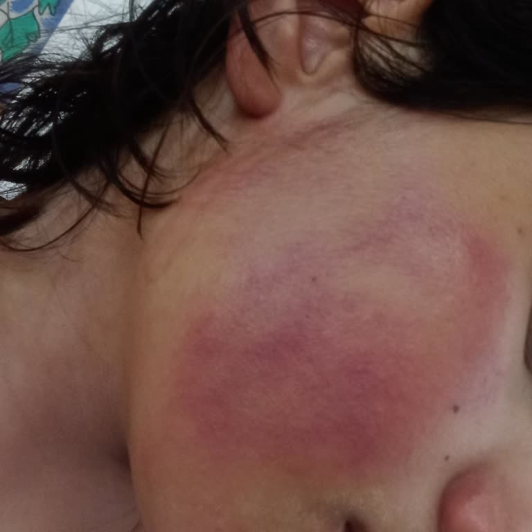 Garnier Cilt Bakım Ürünü Kullanımı Sonrası Yanma Şikayeti