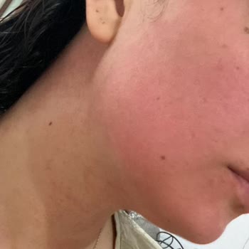 Gratis Yüzüm Yandı Pirinç Maskesi İnsan Sağlığını Hiçe Saydınız.