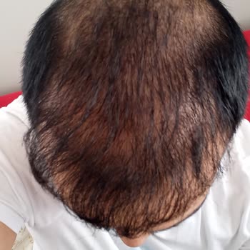 Estego Clinic Saç Ekimi