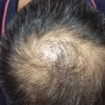 Estego Clinic Saç Ekimi