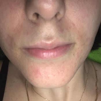 Bioderma Güneş Kremi Alerji Yaptı