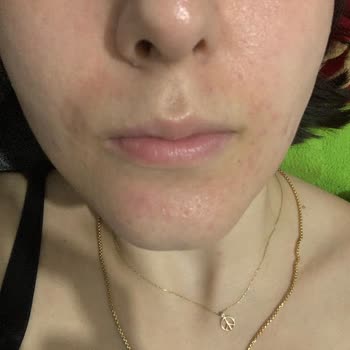 Bioderma Güneş Kremi Alerji Yaptı