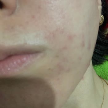 Bioderma Güneş Kremi Alerji Yaptı