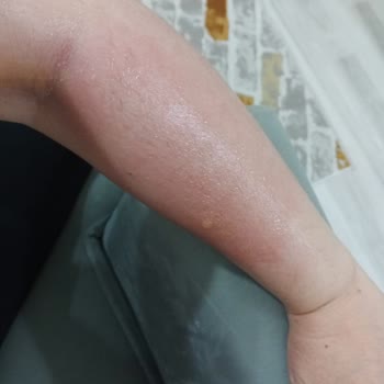 Salihli Devlet Hastanesi Tedavi Gören Annemin Durumu İyi Değil!