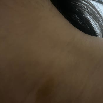 Alerjik Reaksiyonlar Başlatan Rexona Ürünleri