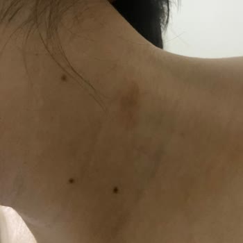 Alerjik Reaksiyonlar Başlatan Rexona Ürünleri