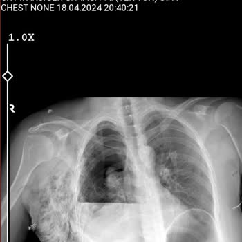 Yedikule Göğüs Hastalıkları Ve Göğüs Cerrahisi Eğitim Ve Araştırma Hastanesi Yedi Kule Göğüs Hastalıkları