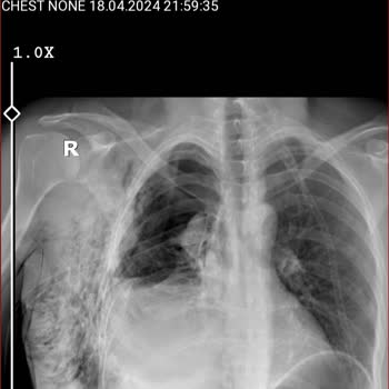 Yedikule Göğüs Hastalıkları Ve Göğüs Cerrahisi Eğitim Ve Araştırma Hastanesi Yedi Kule Göğüs Hastalıkları