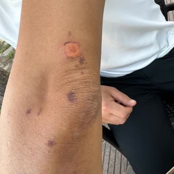 Mona Güzellik & Estetik Lazer Kollarımızı Yaktı