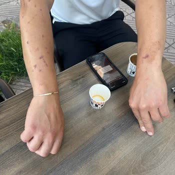 Mona Güzellik & Estetik Lazer Kollarımızı Yaktı