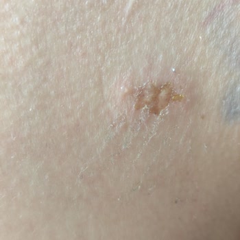 Getwell Yanık İzi Yapıyor