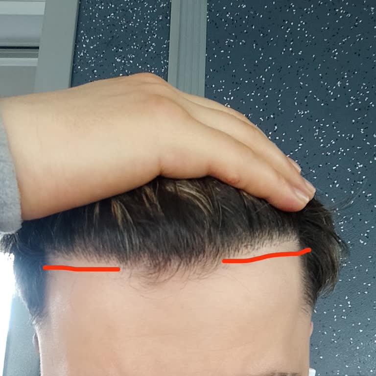 Adem Köse Saç Çizgim Geride