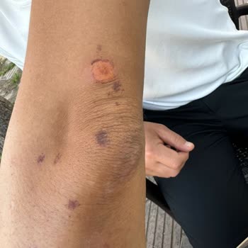 Mona Güzellik & Estetik Lazerde Abimin Kollarını Yanıklar İçinde Bıraktılar!