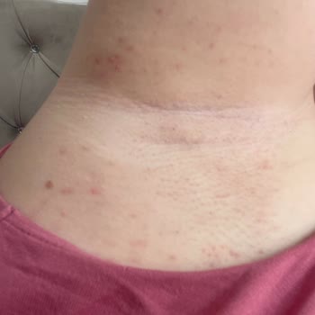 Rexona Koltuk Altımda Sivilce Çıkarttı