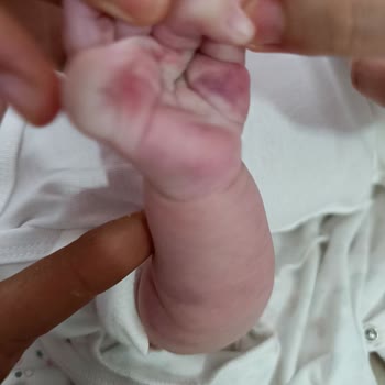 Medihaus Cerrahi Şiddet Mağduru Bebek!