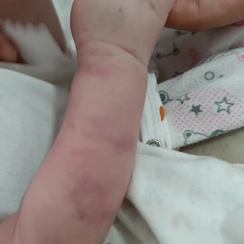 Medihaus Cerrahi Şiddet Mağduru Bebek!