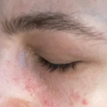 Caudalie Göz Kremi Yan Etki