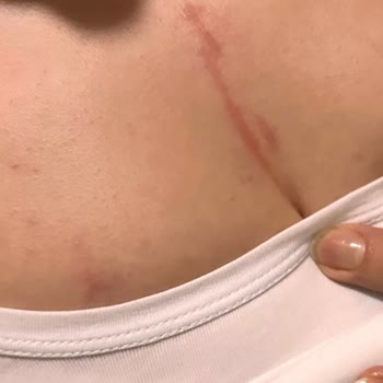 Noora Life Beauty Center Lazer Sonrası Her Yanım Yandı