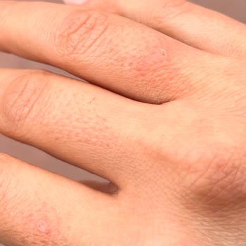 Noora Life Beauty Center Lazer Sonrası Her Yanım Yandı