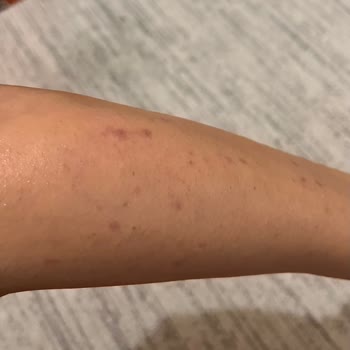 Noora Life Beauty Center Lazer Sonrası Her Yanım Yandı