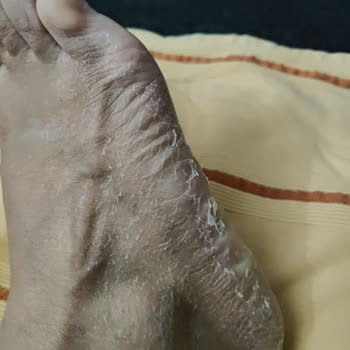 Dermokil Ayak Maskesi Şikayeti