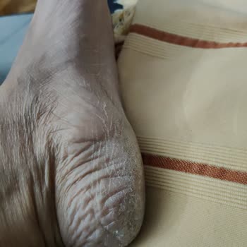 Dermokil Ayak Maskesi Şikayeti