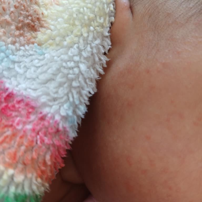 Mustela Stelatopia İsilik Yaptı