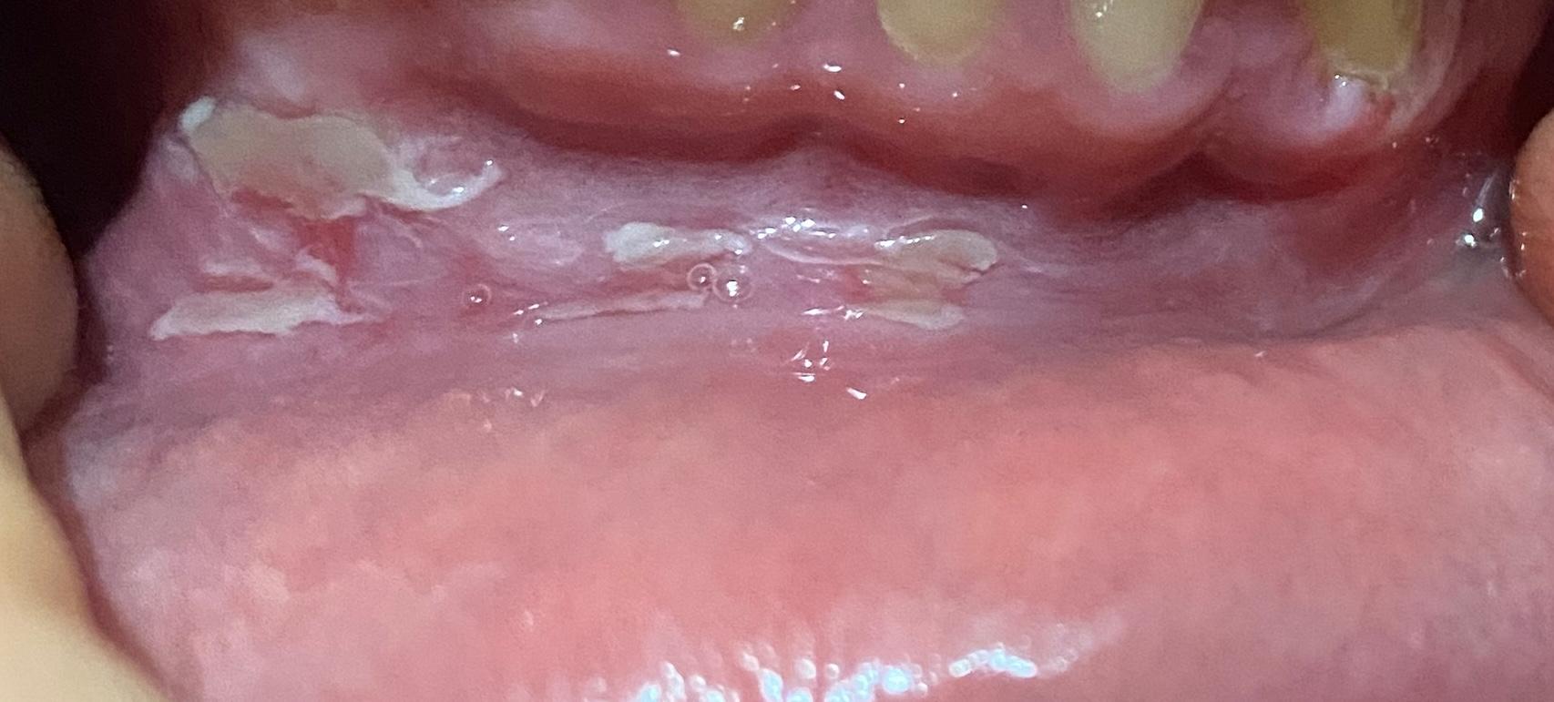 Parodontax Toothpaste Causes Mouth Ulcers and Sores Xolvie