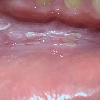 Parodontax Toothpaste Causes Mouth Ulcers and Sores