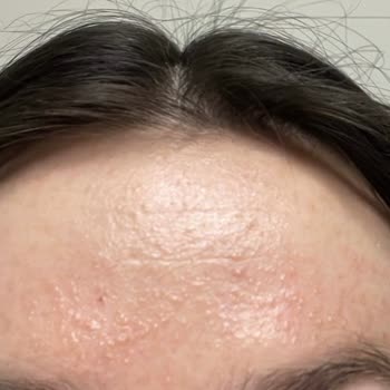 The Purest Solutions The Purest Solution Aydınlatıcı C Vitamini Yüzümü Yaktı!