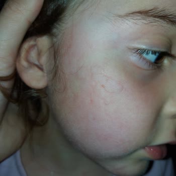 Ozmo Çikolata Alerji Yaptı