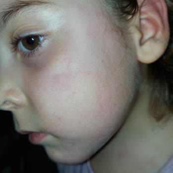 Ozmo Çikolata Alerji Yaptı