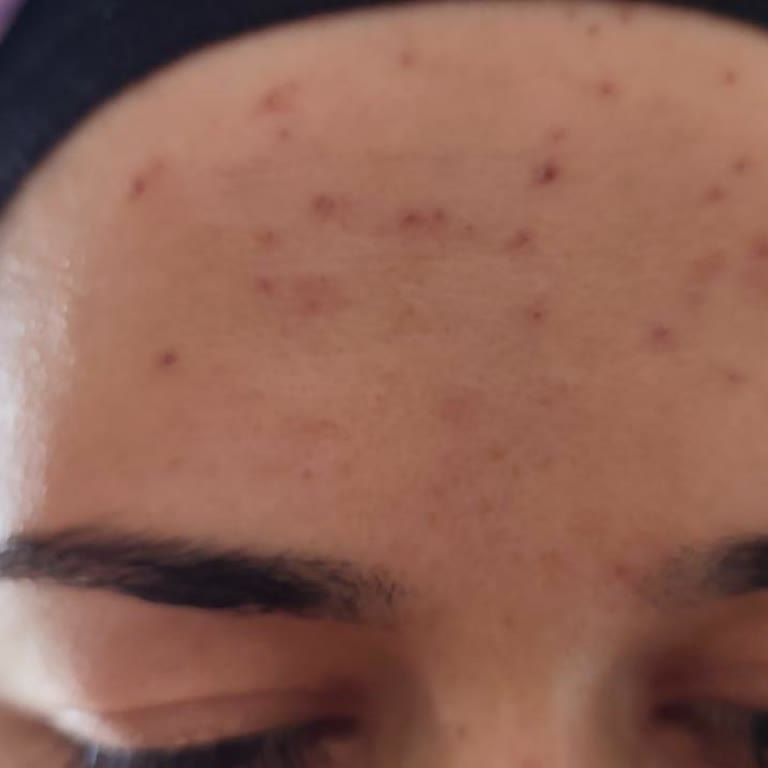 Eva Luxury Güzellik Salonu Cilt Bakımı Hatası