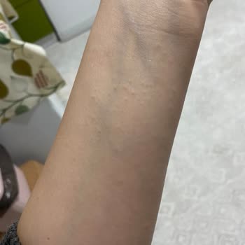 Mustela Çatlak Kremi Alerji