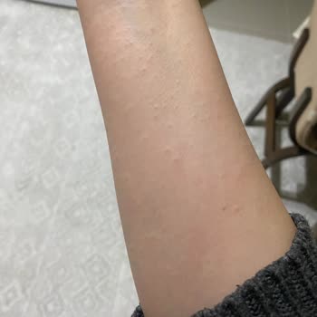 Mustela Çatlak Kremi Alerji