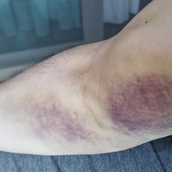 Türk Kızılay Kan Bağışı Kolumu Hissetmiyorum
