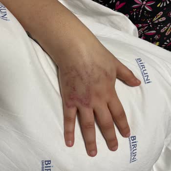 Biruni Üniversitesi Hastanesi Ameliyat Sonrası İhmalkar Bakım Ve Hemşirelerin İlgisizliği