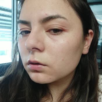 Maruderm Salisilik Asit Yüz Yıkama Jeli Tahriş Ediyor